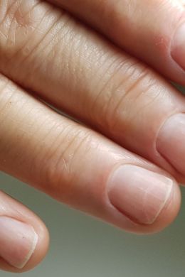 Поперечные вмятины на ногте большого пальца