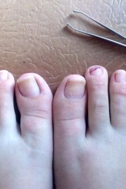Проблемные ногти на ногах