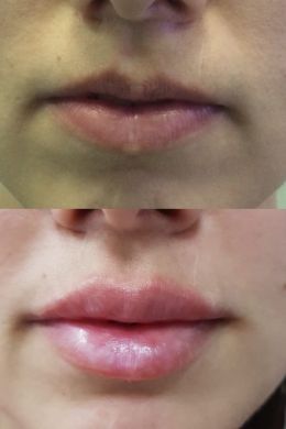 Асимметрия губ