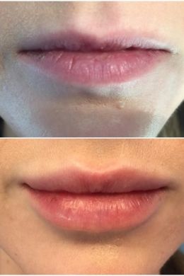 Техники увеличения губ
