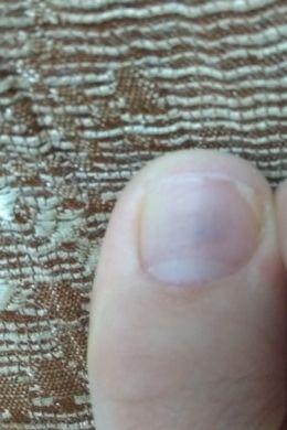 Пятно на ногте большого пальца ноги