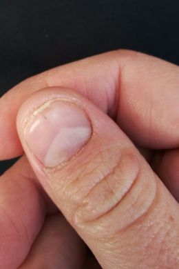 Черные полоски на ногтях рук