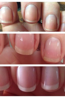Повреждение матрицы ногтя