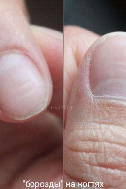 Продольные борозды на ногтях рук