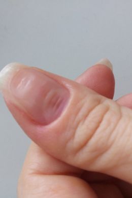 Трещины на пальцах рук около ногтя