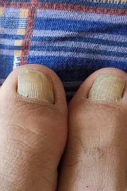 Трещина на ногте большого пальца ноги
