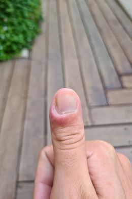Трещина на ногте большого пальца