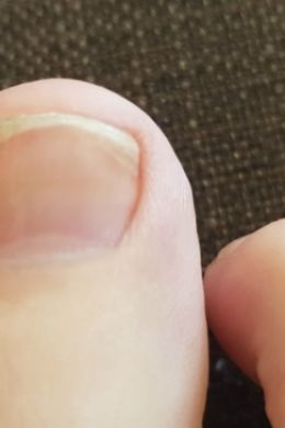 Трещина на ногте большого пальца руки