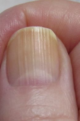 Продольные полосы на ногтях рук