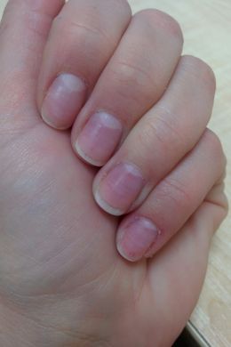 Продольные полоски на ногтях рук