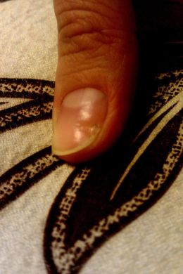 Ямка на ногте большого пальца