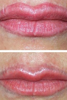 Удаление перманентного макияжа губ лазером