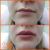 Асимметрия нижней губы