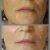 Эффект тиндаля на губах