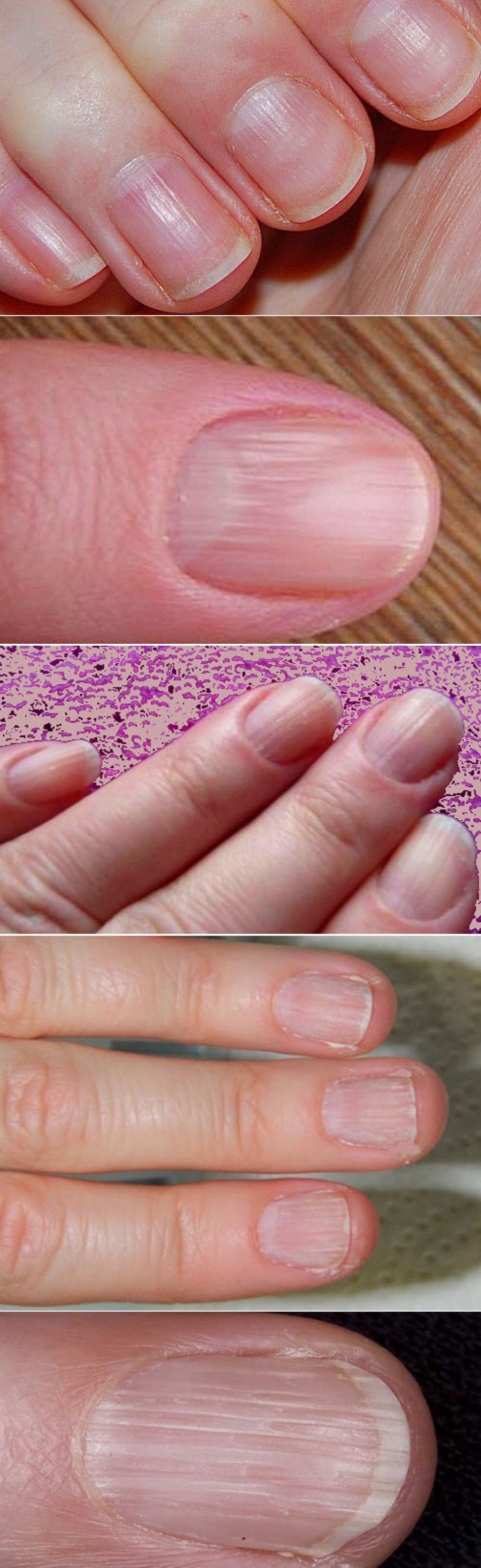 Ребристые полосы на ногтях