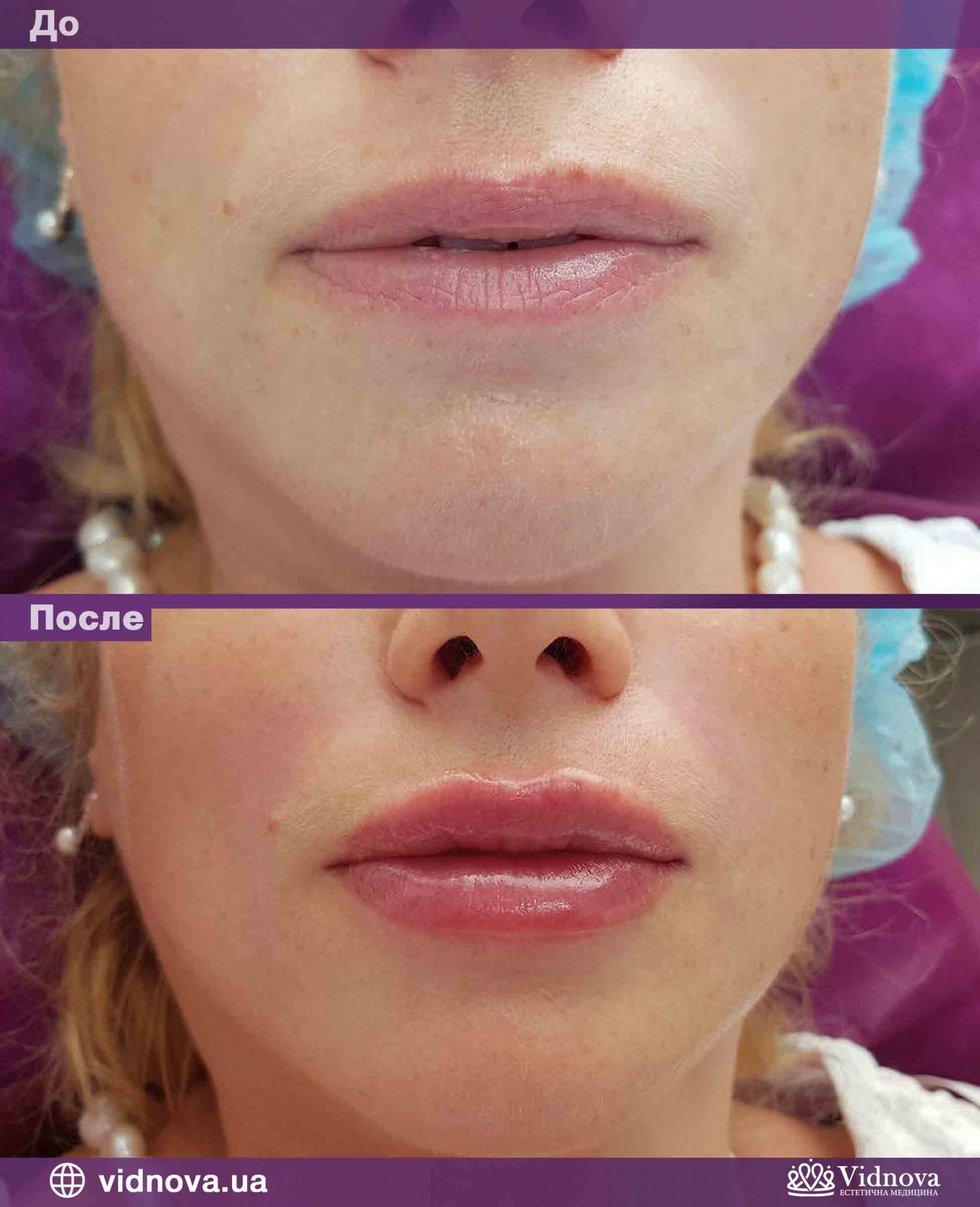 Увеличение губ до и после отзывы. Контурная пластика губ принцесс волюм. Техники контурной пластики губ филлерами.