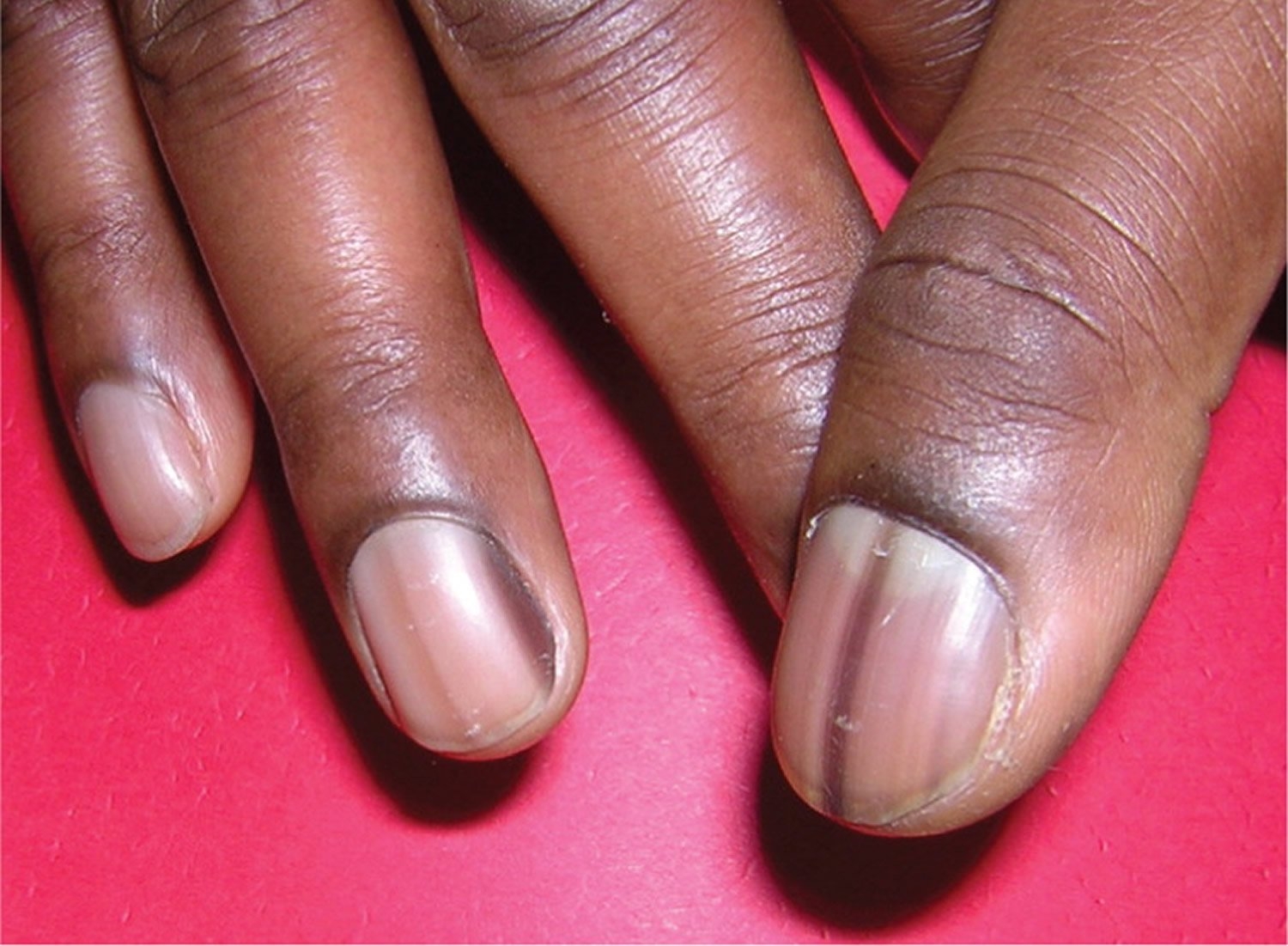 Полоски на ногтях причины вертикальные у женщин. Ониходистрофия, лейконихия. Подноктевавая меланома. Околоногтевая меланома.