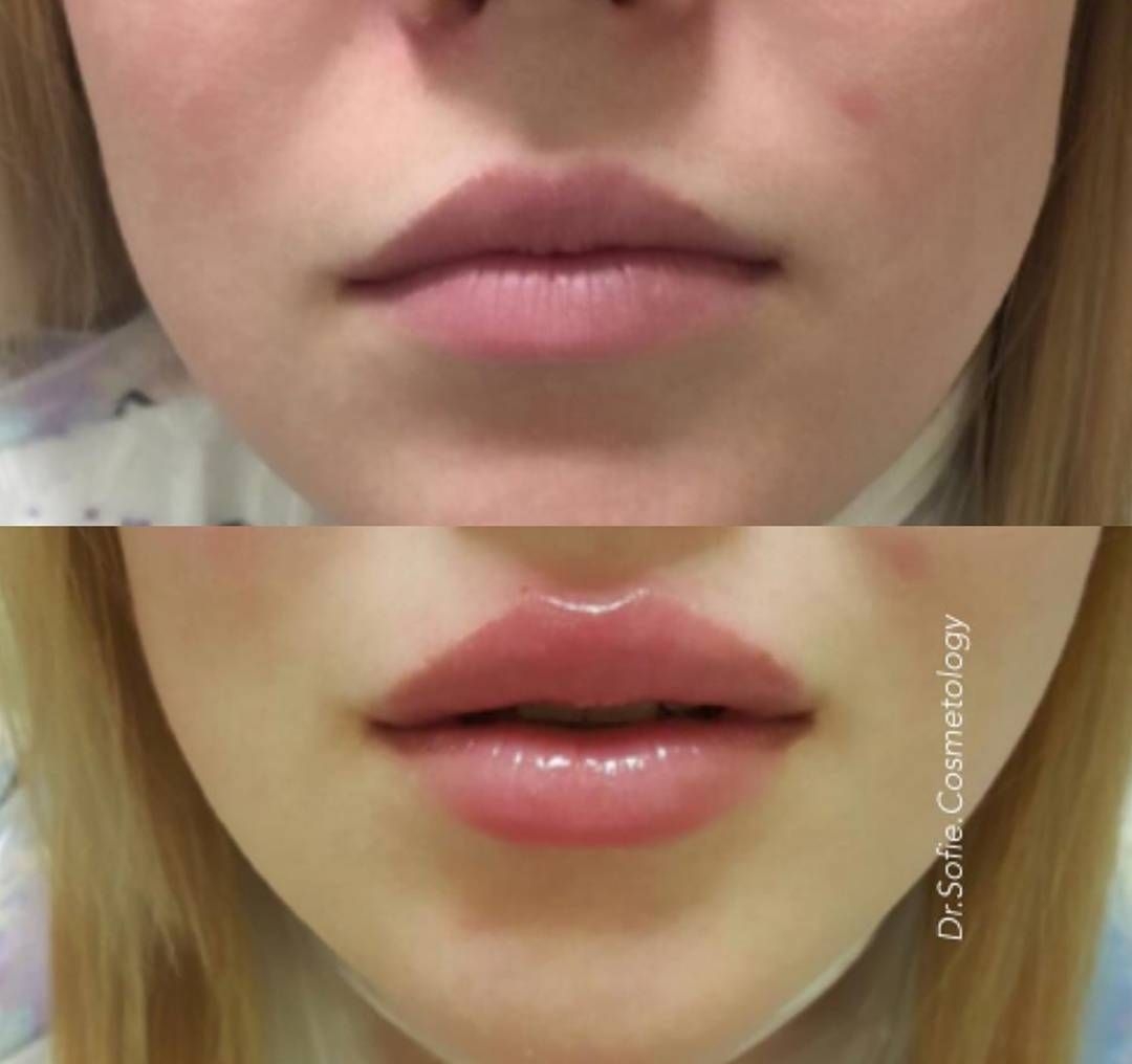 Увеличение губ lips. Увеличенные губы красивые. Натурально увеличенные губы.