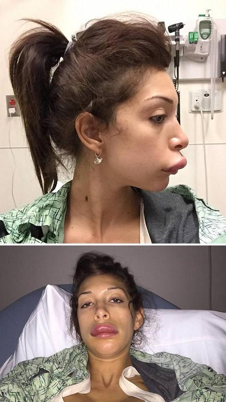 Сэмми льюис до и после. Неудачное увеличение губ. Неудачные операции на губы. Ужасные пластические операции.
