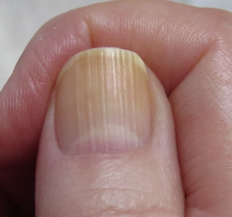 Продольные полосы на ногтях рук
